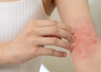 Esporotricose Humana em Marituba: Conheça os Sintomas da Doença Fúngica