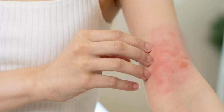 Esporotricose Humana em Marituba: Conheça os Sintomas da Doença Fúngica