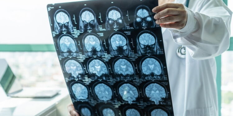 Síndrome de Guillain-Barré: Sintomas, Causas e Tratamentos Eficazes