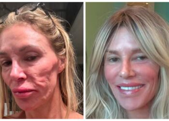 Brandi Glanville revela valor gasto para solucionar problema de saúde