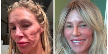 Brandi Glanville revela valor gasto para solucionar problema de saúde