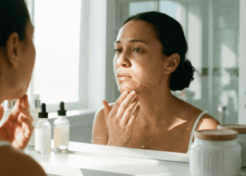 Como Cuidar da Pele com Acne Adulta Após os 30 Anos