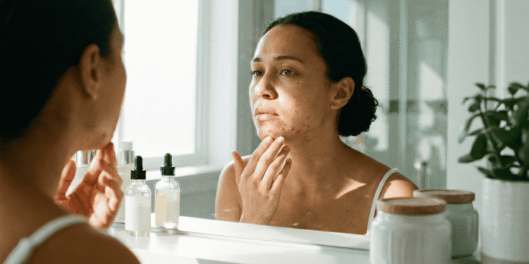 Como Cuidar da Pele com Acne Adulta Após os 30 Anos
