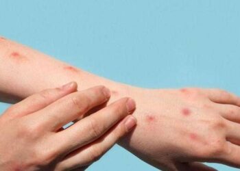 Monitoramento da Mpox no Brasil Continua Após Detecção de Nova Variante