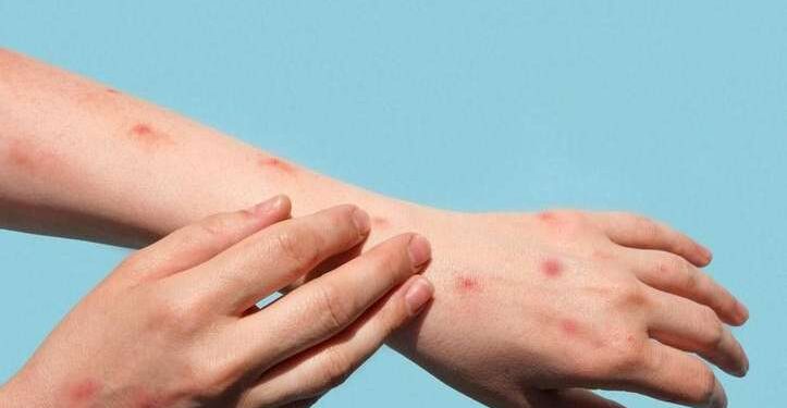 Monitoramento da Mpox no Brasil Continua Após Detecção de Nova Variante