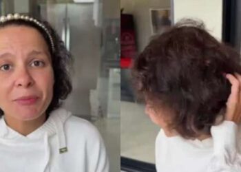 Maiara Revela Luta Contra Alopecia Androgenética: Entenda a Condição