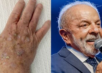 Lula Passa por Procedimento para Remover Queratose: Entenda a Condição e Tratamentos
