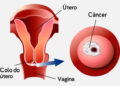 Câncer de Colo de Útero: Causas, Sintomas e Prevenção