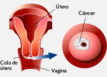 Câncer de Colo de Útero: Causas, Sintomas e Prevenção