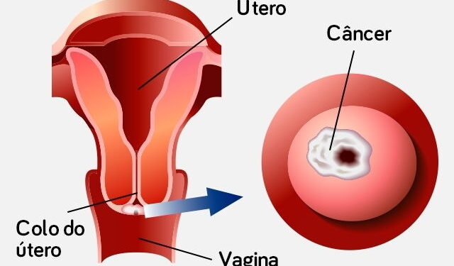 Câncer de Colo de Útero: Causas, Sintomas e Prevenção