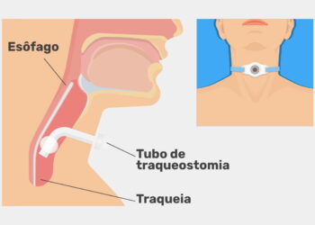 Traqueostomia: Entenda o Procedimento e Suas Indicações
