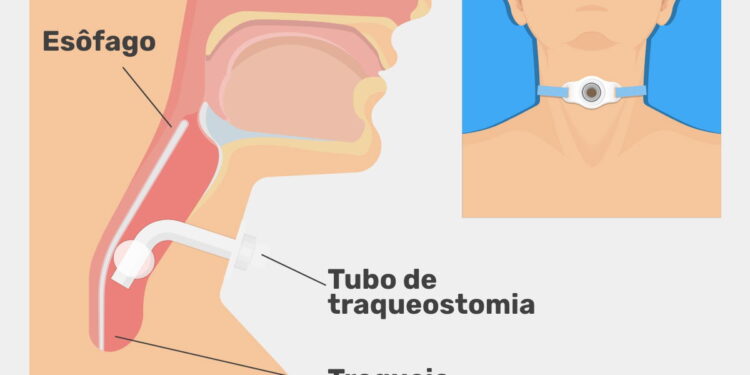 Traqueostomia: Entenda o Procedimento e Suas Indicações