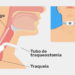 Traqueostomia: Entenda o Procedimento e Suas Indicações